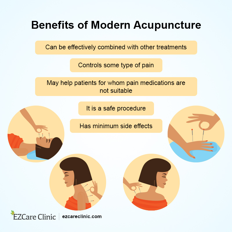 Modern Acupuncture Benefits